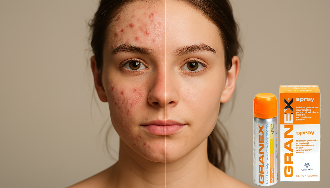 GRANEX – Anti-Acne Spray Foam