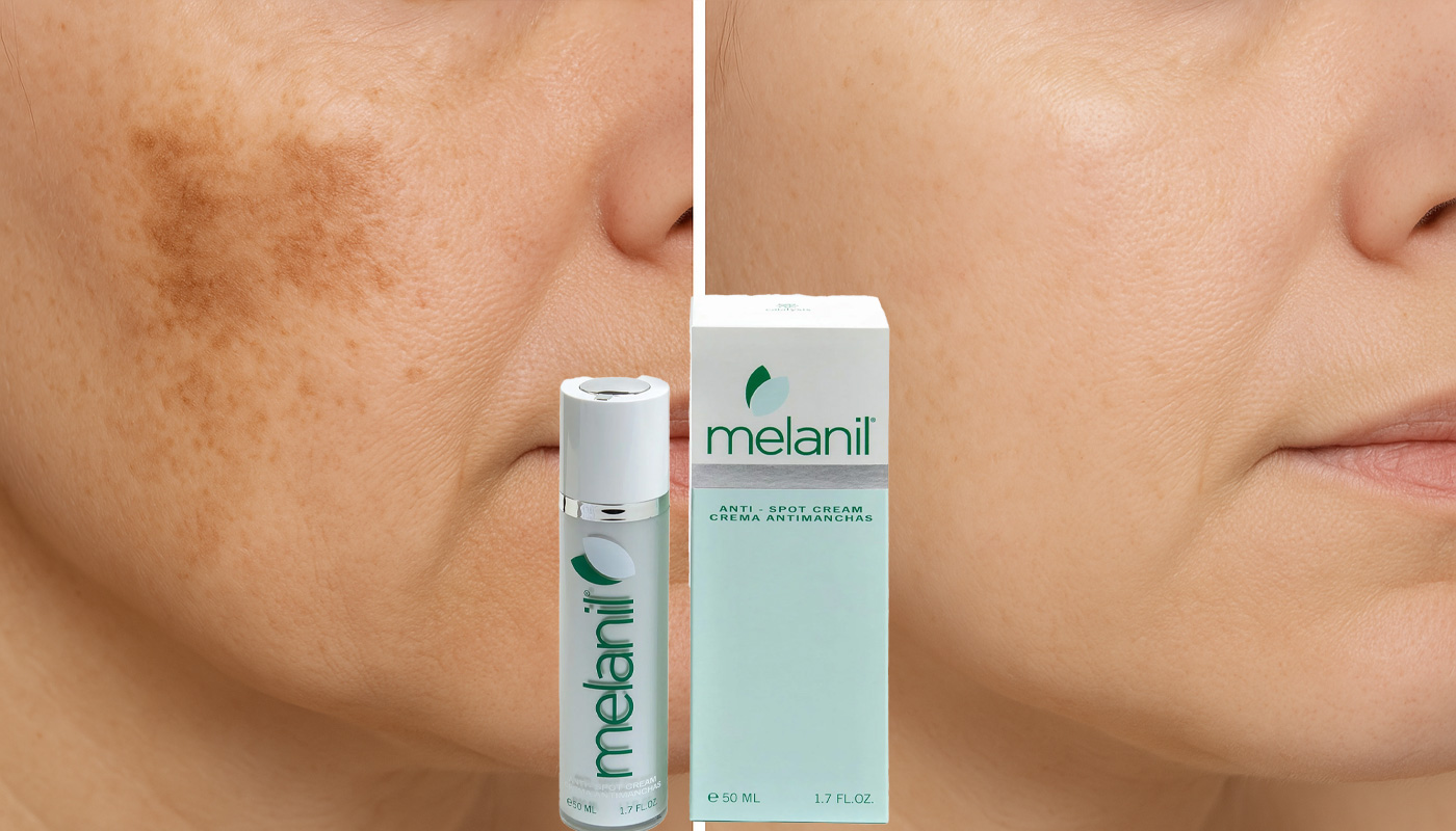 MELANIL – High-Performance Depigmenting Cream